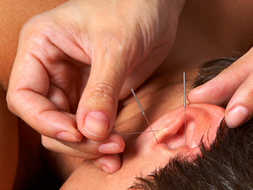 Acupuntura Auricular - Yoga Mooca